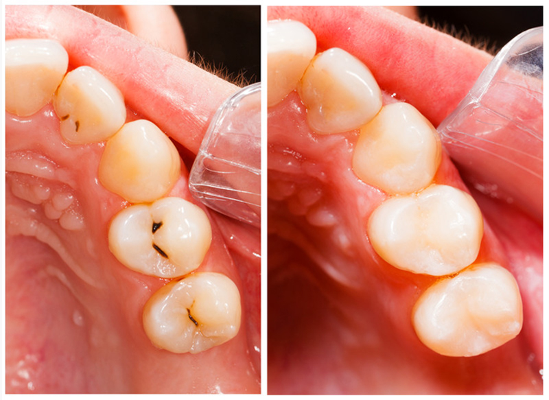Fillings Mill Valley, CA