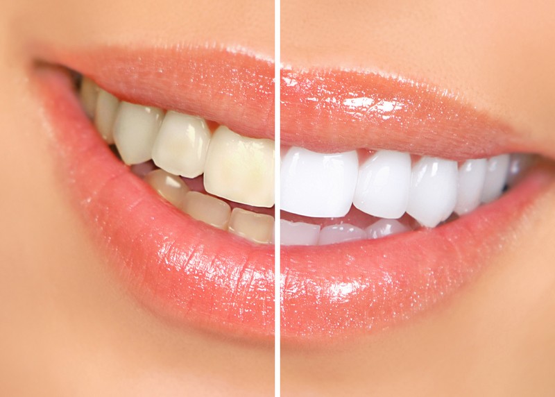 Teeth Whitening Mill Valley, CA